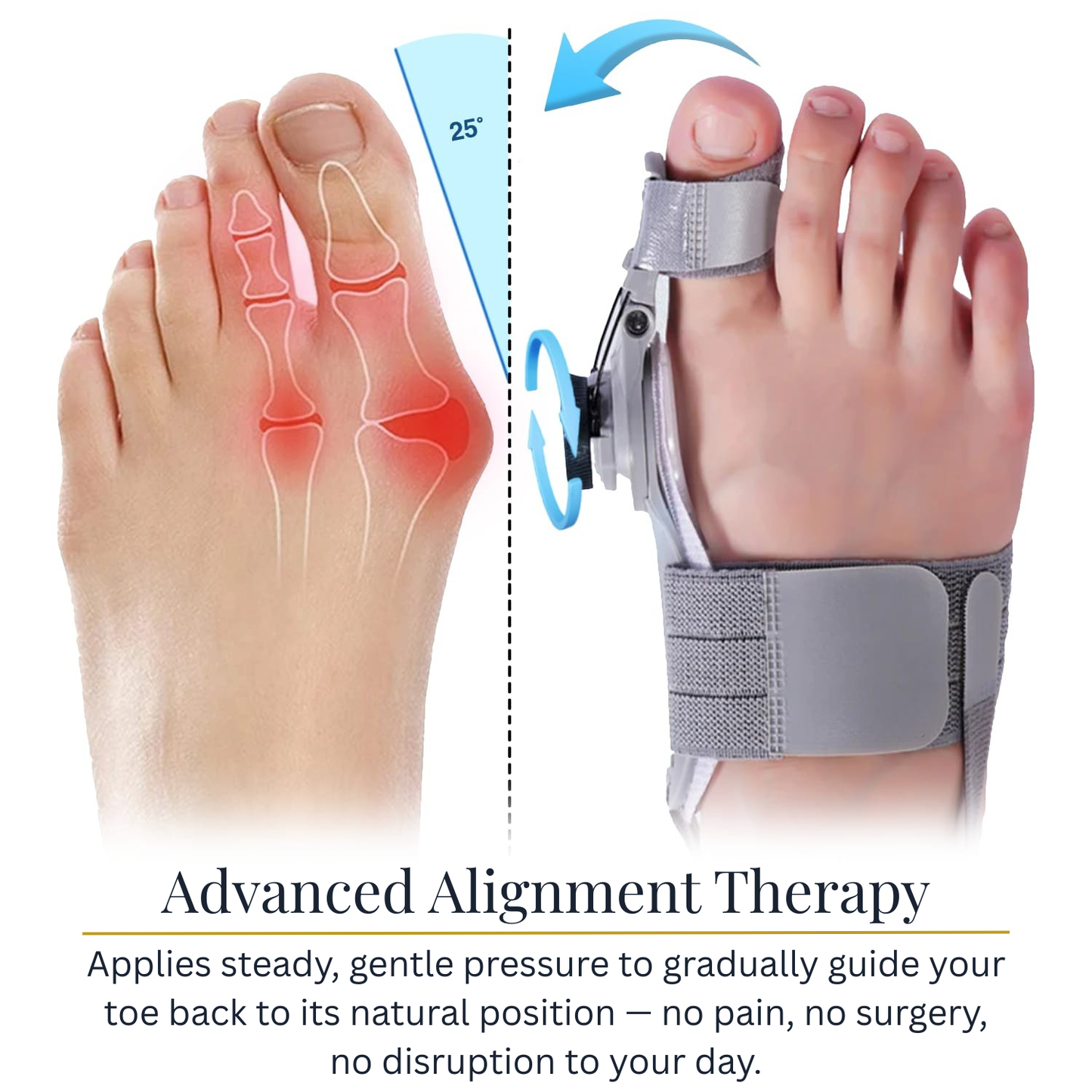 Halluxa™ - Correct Your Bunion Without Surgery