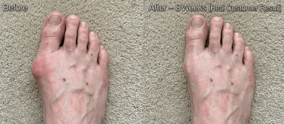 Before: bunion pain  ·  After: Halluxa realignment — 25° correction
