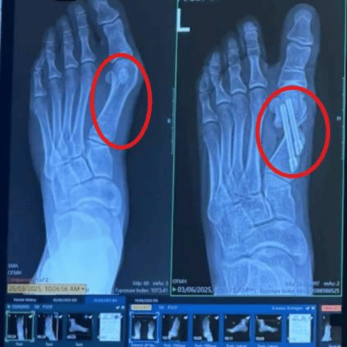 Cutting the bone doesn't fix<br><em>why the toe keeps moving out.</em>
