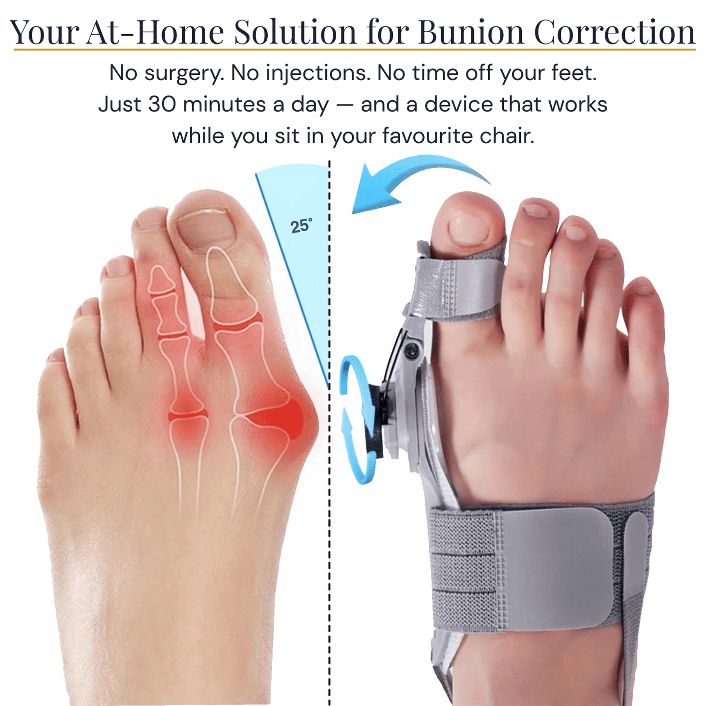 Halluxa™ - Correct Your Bunion Without Surgery
